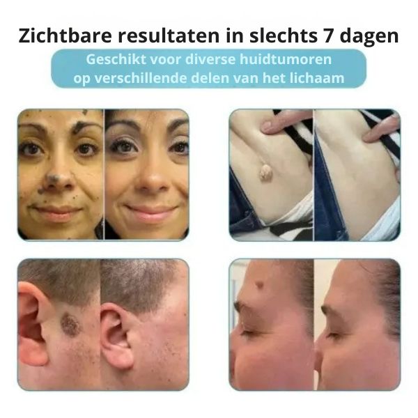 Silk Laser - Precisie en zachtheid in één