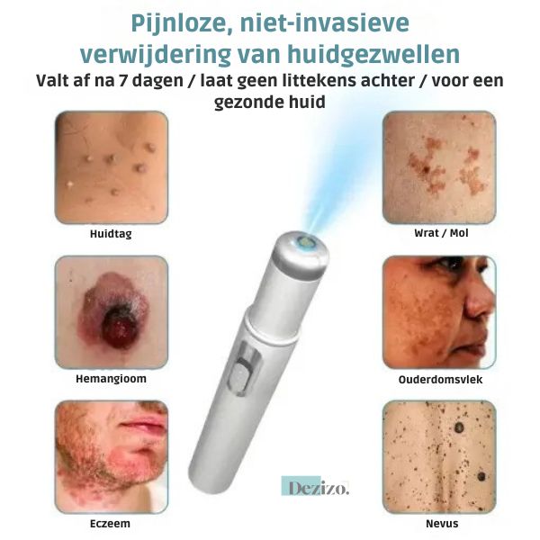 Silk Laser - Precisie en zachtheid in één