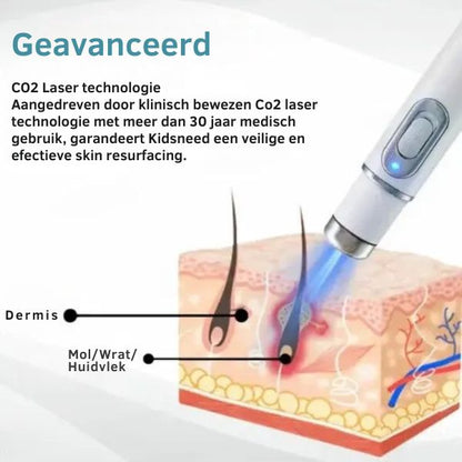 Silk Laser - Precisie en zachtheid in één
